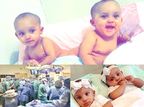 Se recuperan siamesas dominicanas separadas en NY