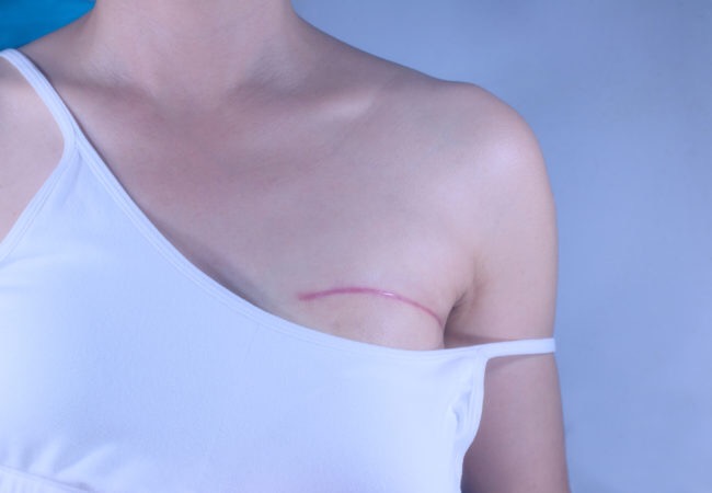 Tratamientos de cáncer de mama aumentan el riesgo de enfermedades cardíacas