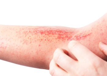 ¿Cómo combatir la dermatitis atópica?