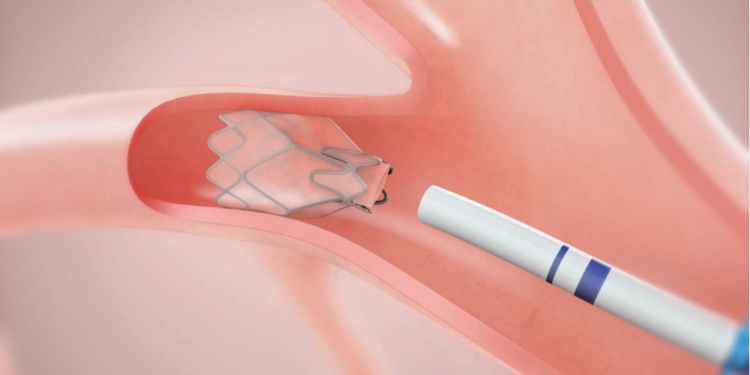 EPOC, enfermedad que mata a una persona cada 10 segundos