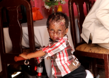 Ronny un niño de la oscuridad que la luz le ocasiona llagas