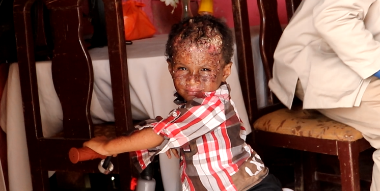 Ronny un niño de la oscuridad que la luz le ocasiona llagas