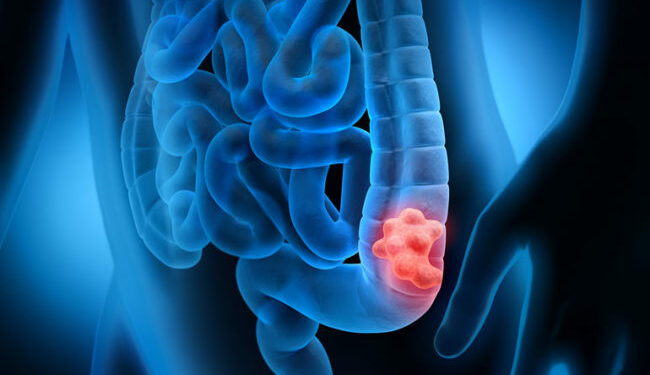 La importancia de realizar pruebas genéticas en pacientes con cáncer de colon