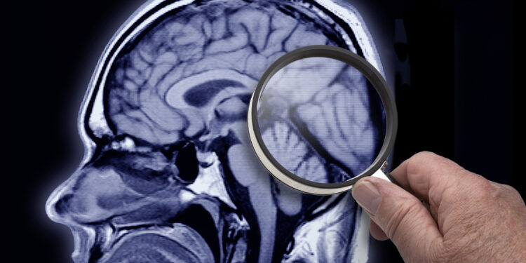 Estudio revela terapia génica con "dedos de cinc" es efectiva para tratar el Alzheimer