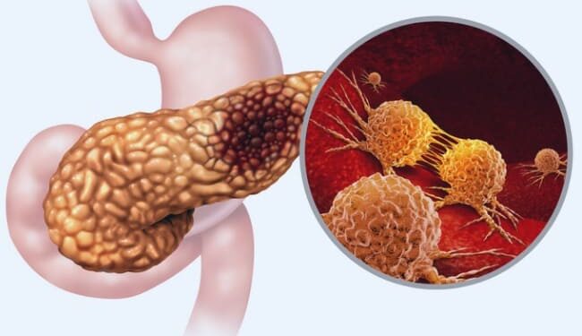 Sed y orina oscura son síntomas para detectar cáncer de páncreas