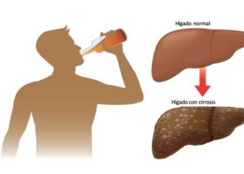 Revelan resultados de pacientes con cirrosis por alcohol tras recuperarse de una enfermedad