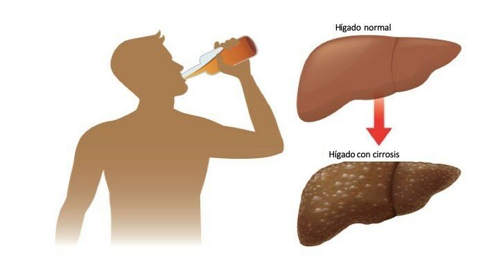Revelan resultados de pacientes con cirrosis por alcohol tras recuperarse de una enfermedad