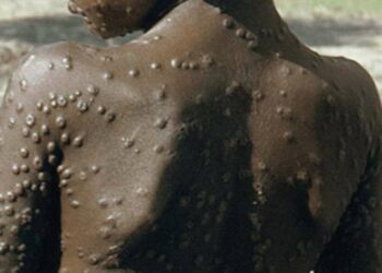 Se expande la viruela del mono  a más de una decena de países 