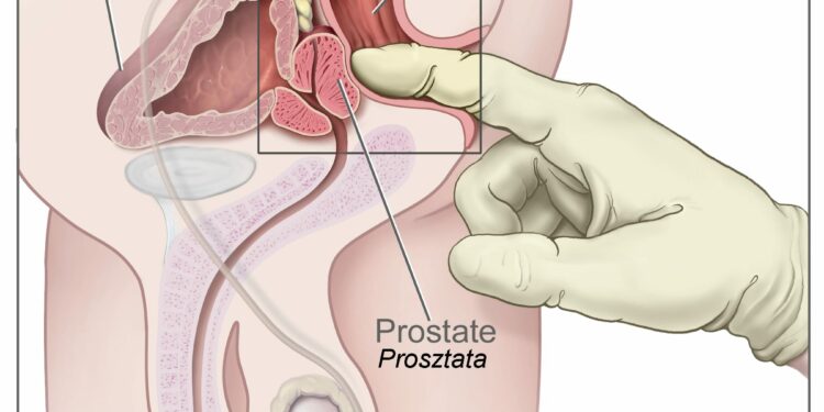 Fumar empeora el pronóstico de los hombres con cáncer de próstata, según un estudio