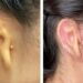 Científicos reconstruyen una oreja con células humanas impresas en 3D