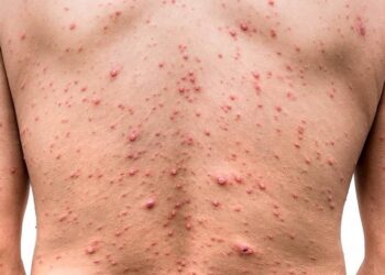 Expertos recomiendan el uso del cubrebocas ante casos de viruela del mono