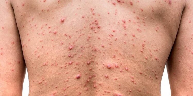 Expertos recomiendan el uso del cubrebocas ante casos de viruela del mono