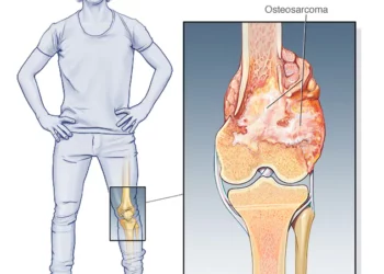 Terapia con haz de protones para cáncer de hueso salva al tejido circundante