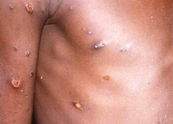 La OMS promueve la vacunación  posexposición de la viruela del mono