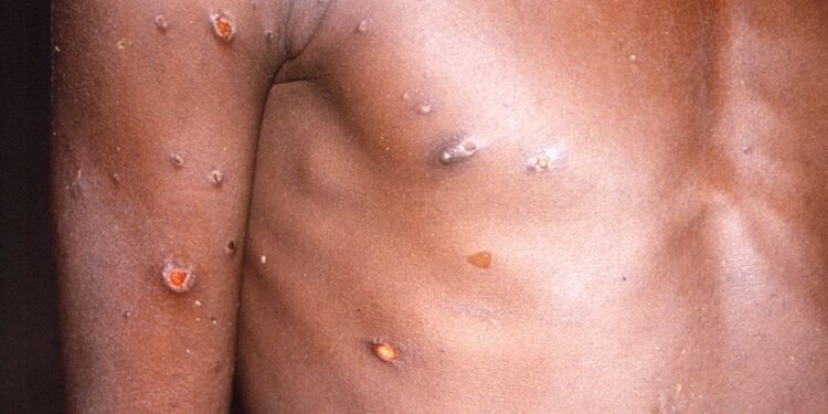 La OMS promueve la vacunación  posexposición de la viruela del mono