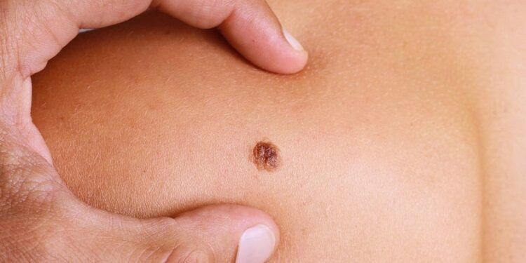 FDA advierte sobre uso productos en lunares y verrugas