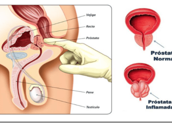 La próstata agrandada tratada con vapor de agua