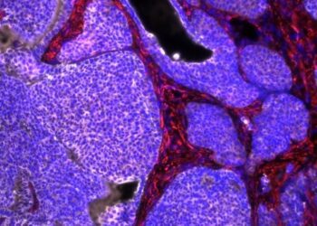 Descubren un nuevo bloqueador molecular que frena la metástasis del cáncer de mama