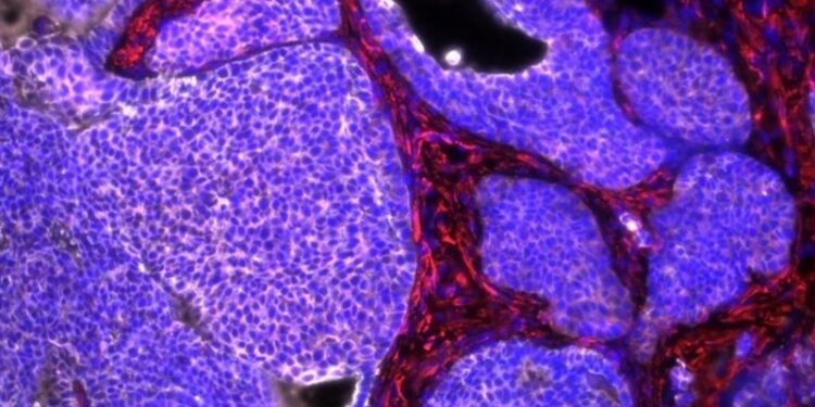 Descubren un nuevo bloqueador molecular que frena la metástasis del cáncer de mama