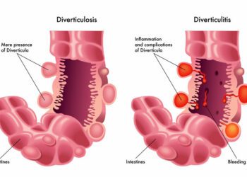Divertículos en el colon: un problema silencioso