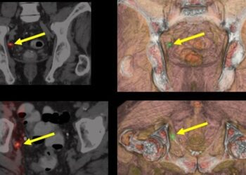 Terapia focal y protonterapia para cáncer de próstata: avances clínicos