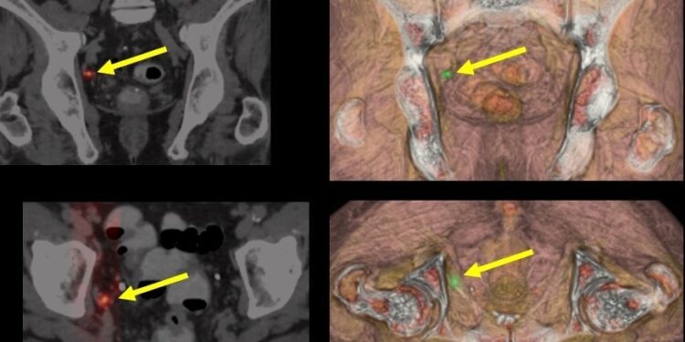Terapia focal y protonterapia para cáncer de próstata: avances clínicos