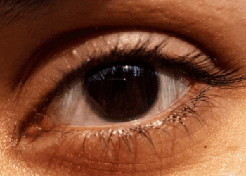 Avances esperanzadores en la lucha contra la aniridia