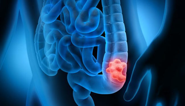 Infección infantil por bacteria podría desencadenar cáncer colorrectal joven