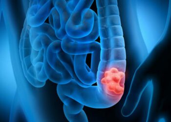 Colonoscopia y test en heces detectan por igual cáncer colorrectal