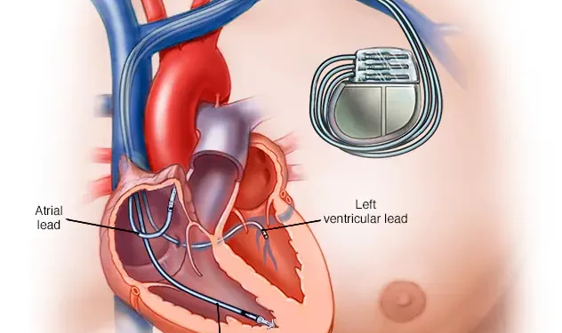 Fin al mito: pacientes con marcapasos no corren peligro cerca de aparatos eléctricos